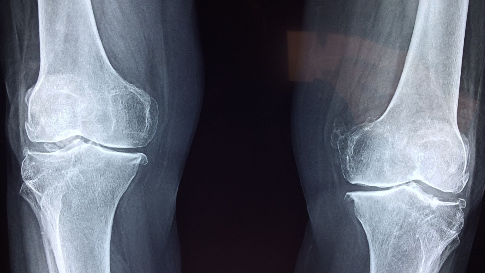 Can Rain Really Make Joint Pain Worse? Experts Explain